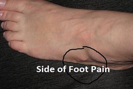 10 Causes for Side of Foot Pain or Lateral Ankle Pain