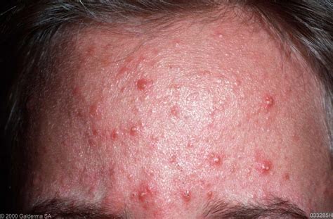 folliculitis on face - pictures, photos