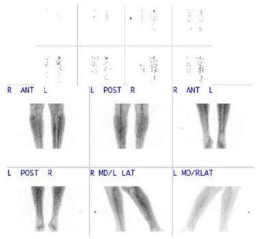 Stress Fracture Tibia Bone Scan