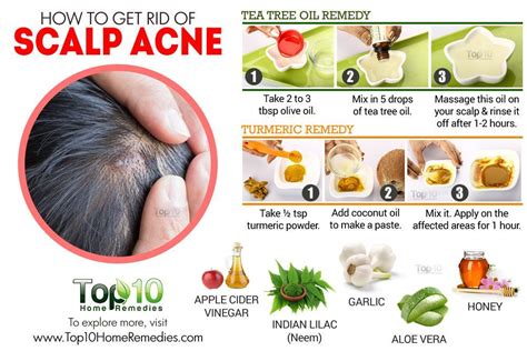 how to get rid of scalp acne Diy Pimple Treatment, Cystic Acne ...