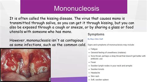 Mononucleosis Symptoms : 10 Signs and Symptoms of Mononucleosis ...