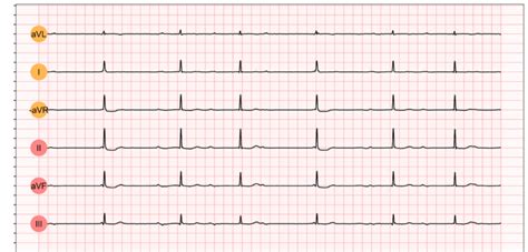 Third-degree AV block (3rd degree AV block, AV block 3, AV block III ...