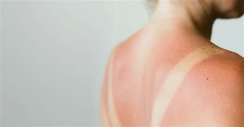 Sun Damage Treatment Treatment Options: What is Sun Damage Treatment ...