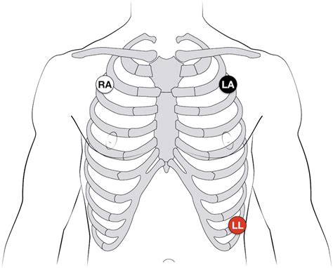 ECG Lead positioning • LITFL • ECG Library Basics