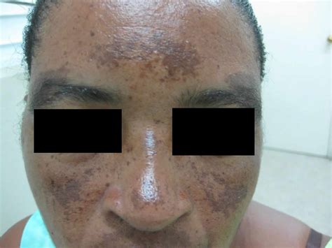 Melasma causes, symptoms, diagnosis & best treatment for melasma on face