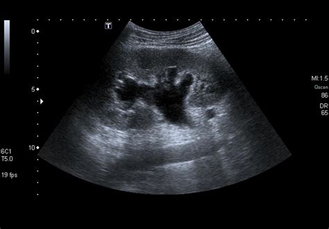 Hydronephrosis echocardiography or ultrasound - wikidoc