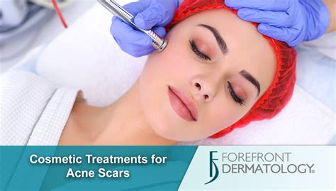 Cosmetic Treatments for Acne Scarring - Forefront Dermatology