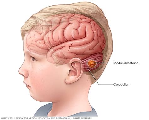 Medulloblastoma - Overview - Mayo Clinic