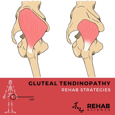 Gluteal Tendinopathy - Rehab Science