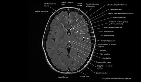 Approach to MRI brain | LearningNeurology.com