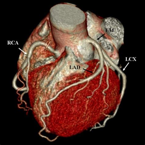 Volume rendering image shows the branches of coronary a | Open-i