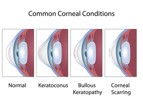 Advantages and Disadvantages of Cornea Transplant and Scleral Lenses ...