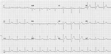 Electrocardiogram Normal Sinus Rhythm