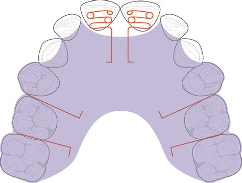 Early Treatment of Anterior Crossbite Relating to Functional Class III ...