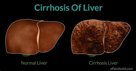 Cirrhosis Symptoms | tenderness.co