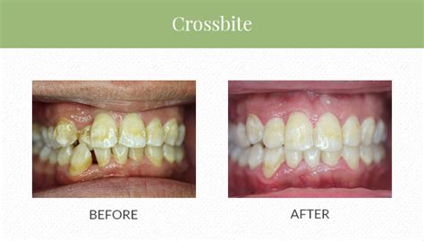 How To Fix A Crossbite In A Child / Read about the options including ...