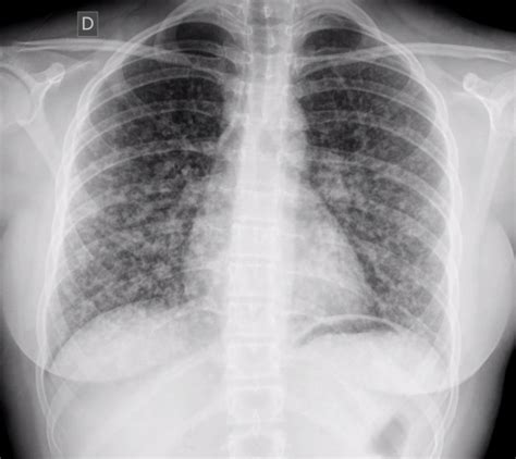 Papillary thyroid cancer chest x ray - wikidoc