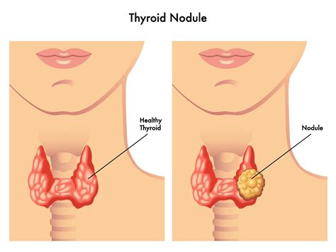 Thyroid Nodule Biopsy and Minimally Invasive Surgery - Advanced ENT ...