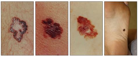 Genetics of Skin Cancer (PDQ®) - NCI