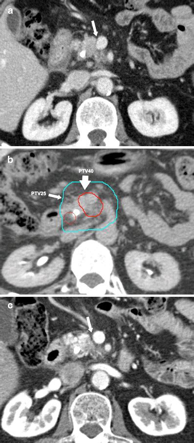 Pancreatic protocol CT of the abdomen (venous phase) illustrating ...