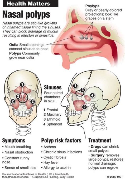 Носни полипи | Лечение на носни полипи | Лечение, Поло