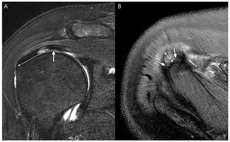 Diagnostics | Free Full-Text | Delaminated Tears of the Rotator Cuff ...