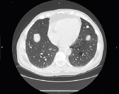 Metastases to the lungs. | Download Scientific Diagram