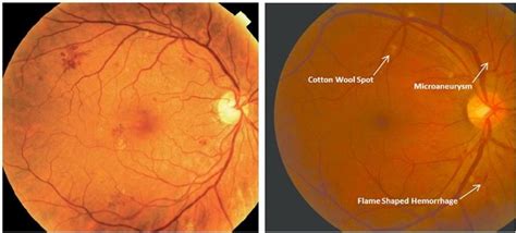 Retinal image with some DR features: Mild-non-proliferative diabetic ...