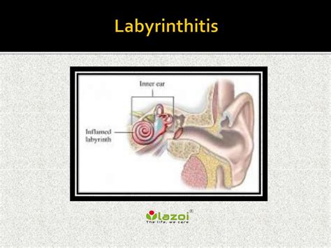 PPT - Labyrinthitis: Causes, Symptoms, Daignosis, Prevention and ...