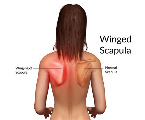 Top 8 Best Winged Scapula Exercises That Bring Quick Relief | New ...