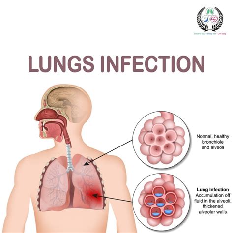 Lung Infection: Types, Symptoms, Treatment Guide