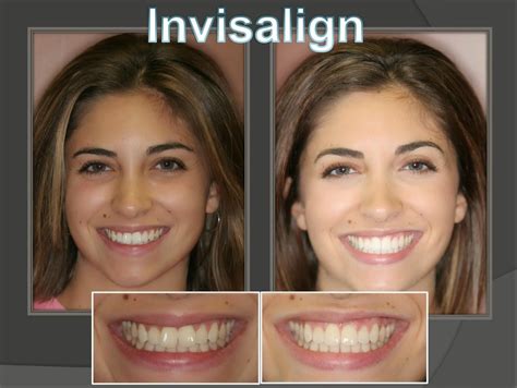 Dentist Orlando Florida: Invisalign | Invisalign, Natural transition ...