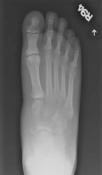 Study Medical Photos: Charcot Arthropathy