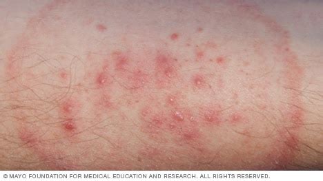 Slide show: Common skin rashes - Mayo Clinic