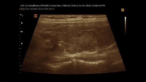 Ultrasound cases 337 of 2000 || Multinodular Goiter