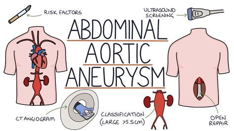 Aortic aneurysm - LaytinPride