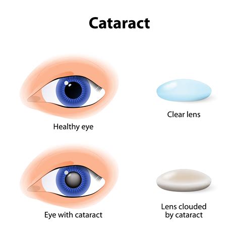 Cataract Center – Eye Associates of Lancaster