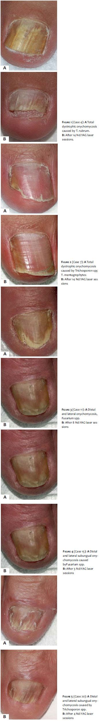 Total Dystrophic Onychomycosis