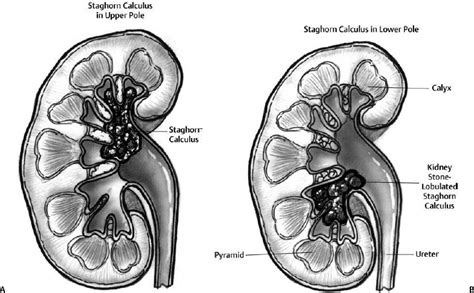 Percutaneous Nephrostomy | Radiology Key