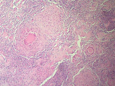 HISTOPATHOLOGY: Mesenteric lymph nodes