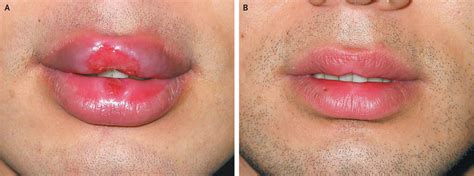 Syphilitic Chancres of the Lips | NEJM