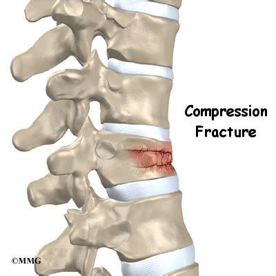 Compression Fracture Lumbar