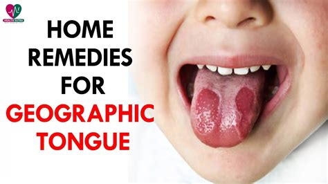 Home Remedies for Geographic Tongue - Health Sutra - YouTube