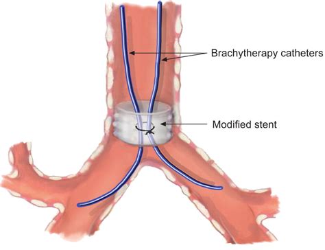 Optimisation of bronchial brachytherapy catheter placement with a ...