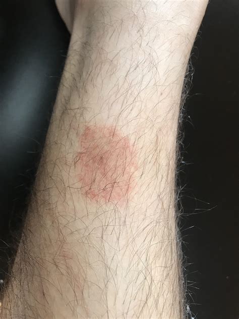 Random rash on leg, any ideas? : r/Dermatology