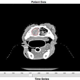 Computed tomographic image of a nasal tumor in transverse plane and ...