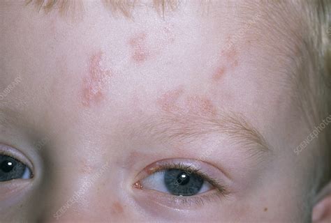 Shingles rash - Stock Image - M260/0281 - Science Photo Library