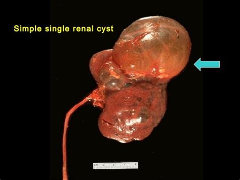 Cystic diseases of kidney