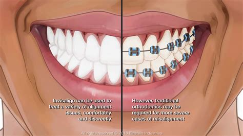 Invisalign vs. Braces - Edmonton, AB