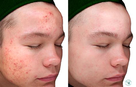 Chemical Peels Photos | Houston, Tx | Patient 10780